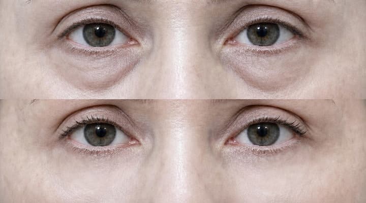 Before and after — International Patient · Fat Repositioning, patient International 01