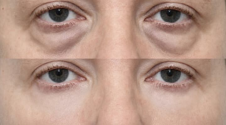 Before and after — International Patient · Lower-Eyelid Correction, patient International 03