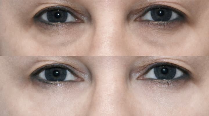 Before and after — International Patient · Fat Repositioning, patient International 05