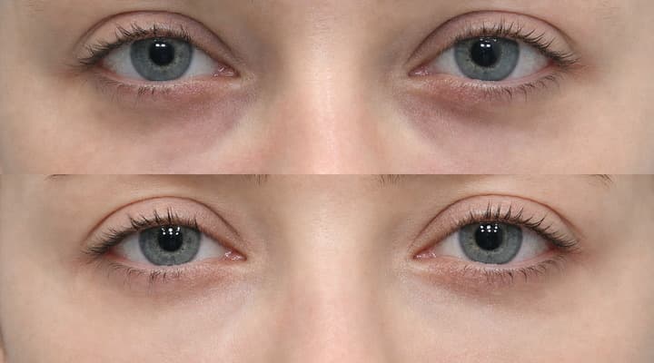 Before and after — International Patient · Fat Repositioning, patient International 07