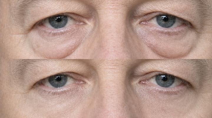 Before and after — International Patient · Lower-Eyelid Correction, patient International 10