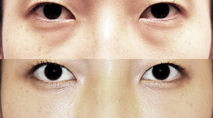 Before and after — 目の下の脂肪再配置, patient Case 08