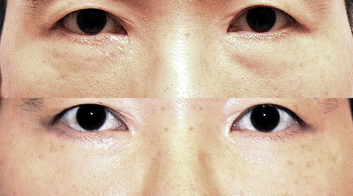 Before and after — 左右差修正, patient Case 06