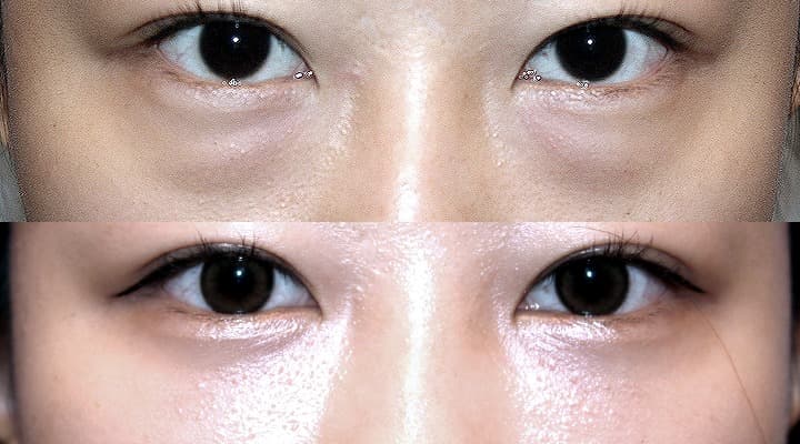 Before and after — 下眼瞼修正手術, patient Case 04