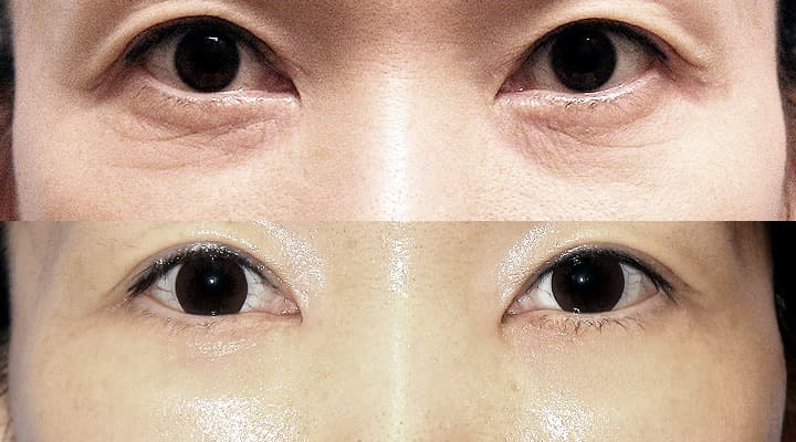 Case 17 目の下 参考術前術後写真