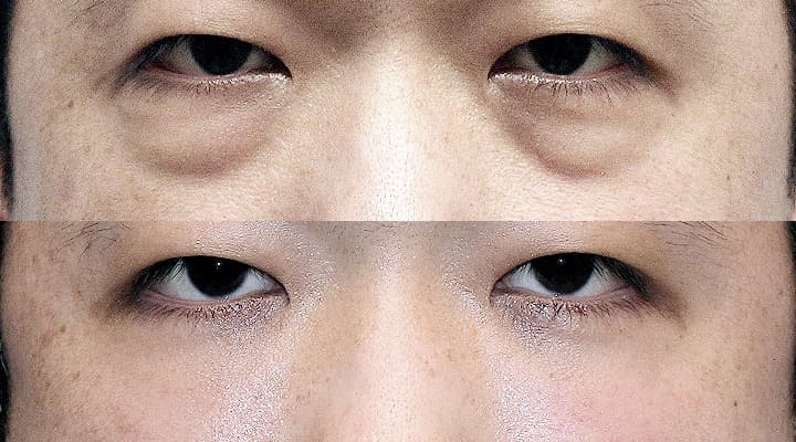 Before and after — 下眼瞼修正手術, patient Case 01
