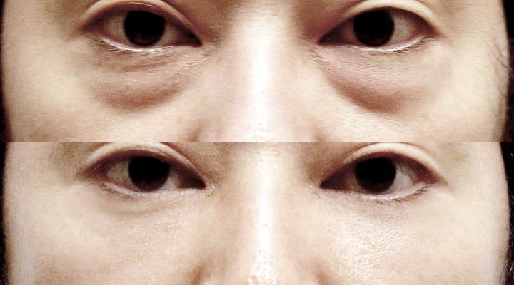 Before and after — 下眼瞼修正手術, patient Case 09
