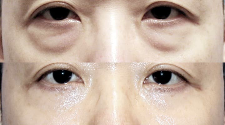 Before and after — 目の下のくぼみ修正, patient Case 11