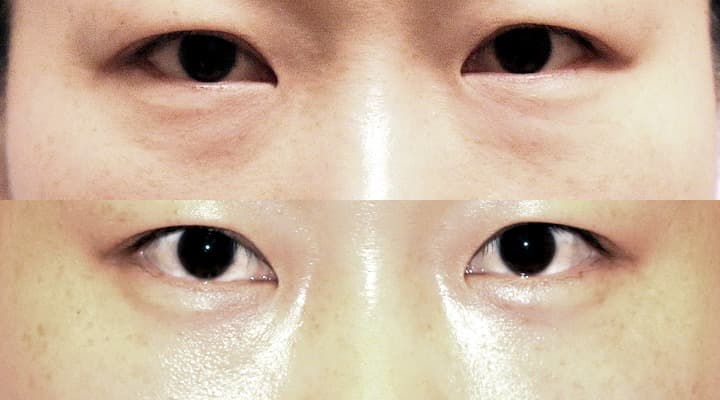 Case 19 目の下 参考術前術後写真