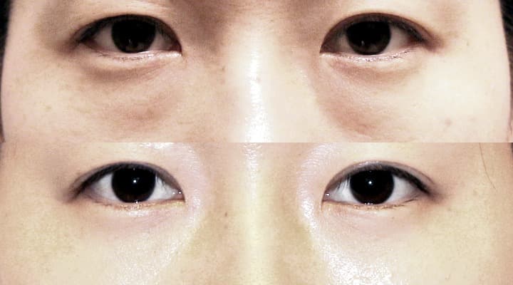 Case 20 目の下 参考術前術後写真