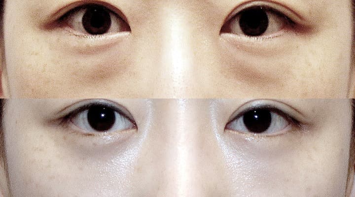 Before and after — 下眼瞼修正手術, patient Case 12