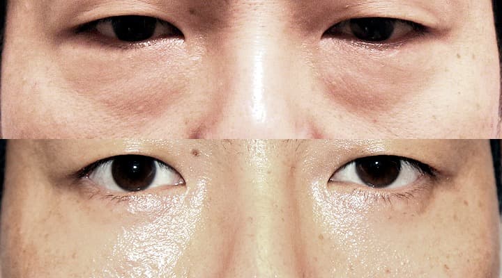 Before and after — 下眼瞼修正手術, patient Case 07