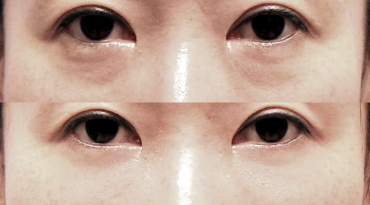 Case 24 目の下 参考術前術後写真