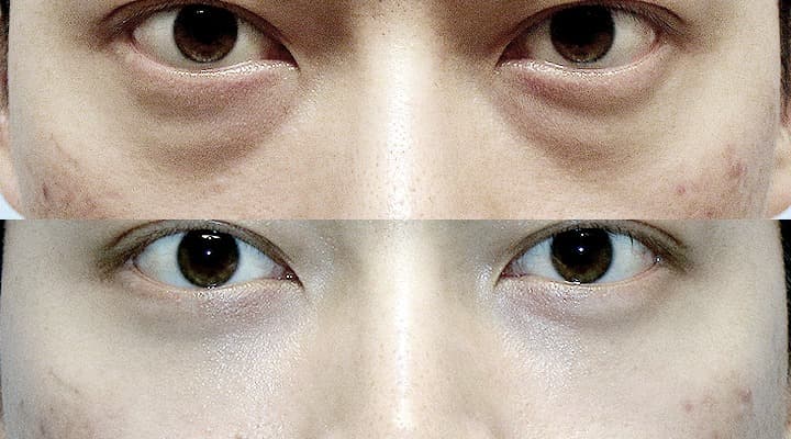 Before and after — 下眼瞼修正手術, patient Case 02