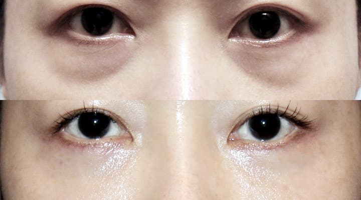Case 18 目の下 参考術前術後写真