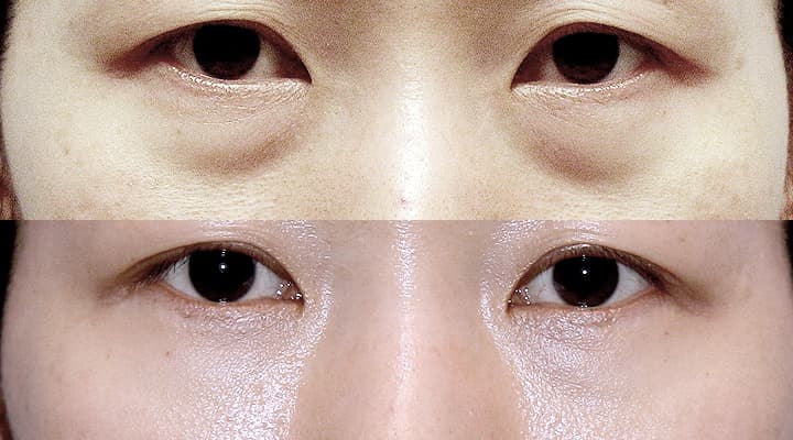 Before and after — 目の下の脂肪再配置, patient Case 03