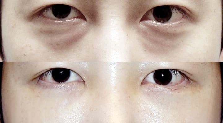 Before and after — 目の下の脂肪再配置, patient Case 10