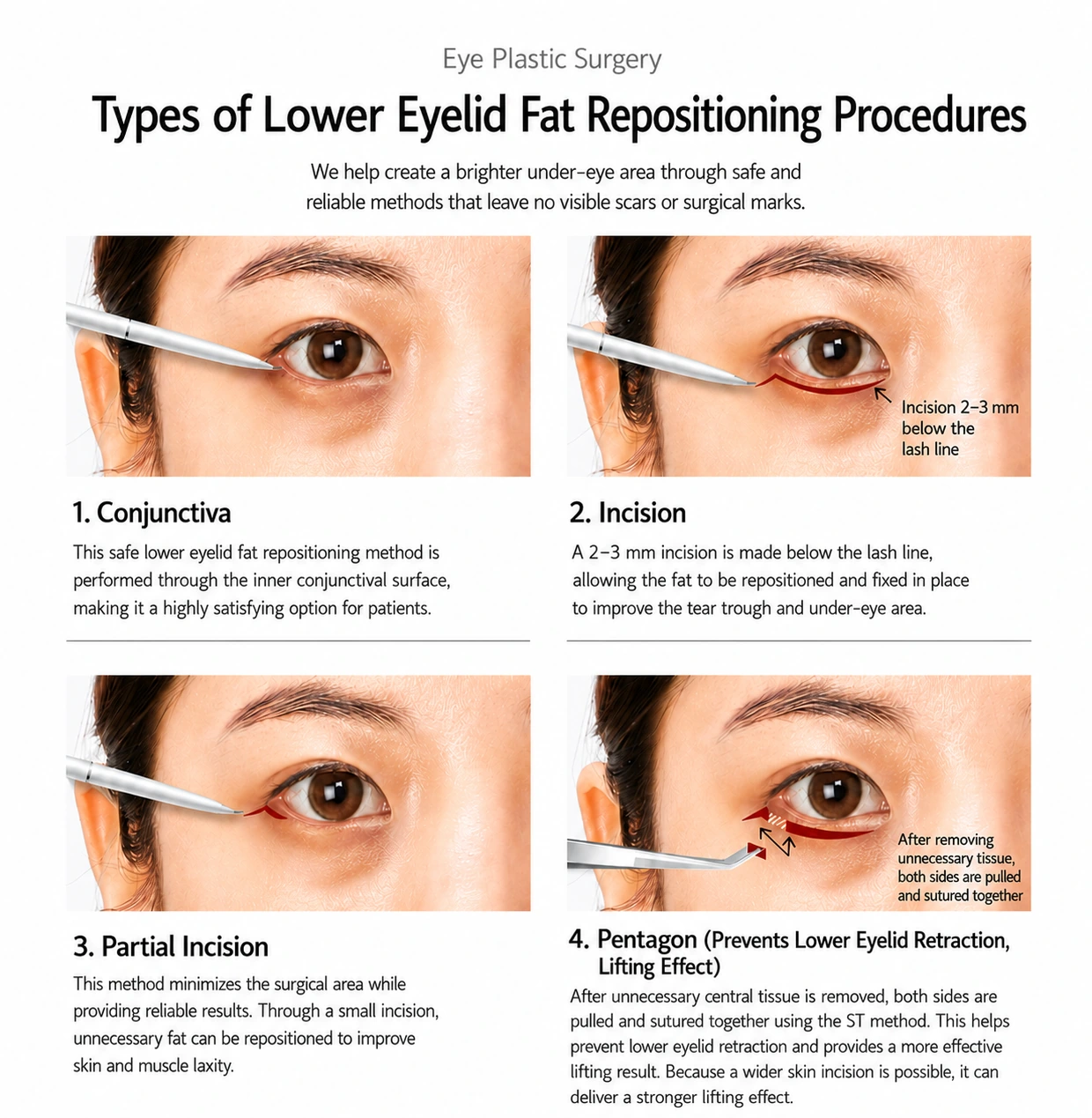 ST’s four under-eye surgical methods — conjunctival, incisional, partial incision, and Pentagon