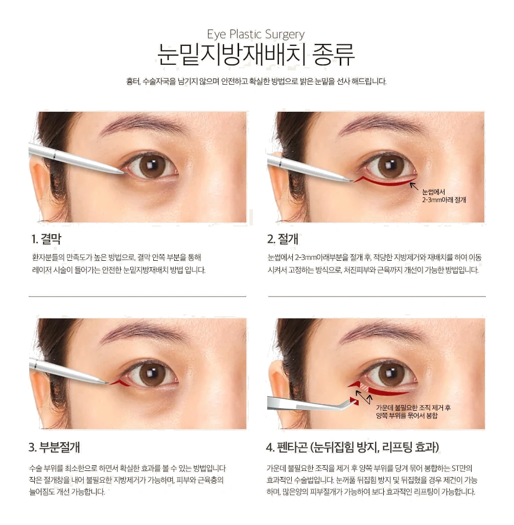 ST’s four under-eye surgical methods — conjunctival, incisional, partial incision, and Pentagon